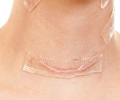 verwijdering litteken herhaal gebruik ISO/CE Silicone Scar Dressing